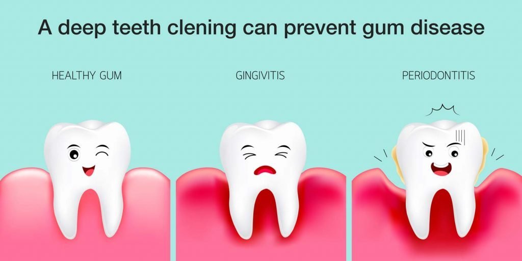 Illustration of three stages of gum health: healthy gum, gingivitis, and periodontitis, with text indicating that deep teeth cleaning can prevent gum disease.