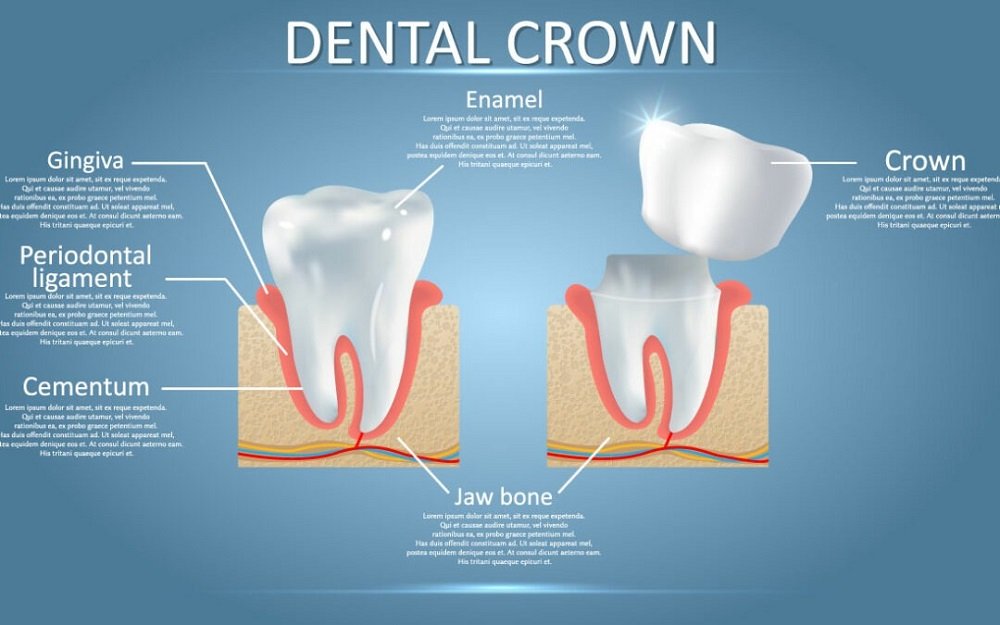 Illustration showing the anatomy of a tooth with a dental crown, including labeled parts such as enamel, gingiva, periodontal ligament, cementum, and jawbone.